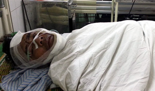 Khuôn mặt anh Y cháy đen. Những vết bỏng ở chân, tay, bụng và mông đã được băng bó lại.