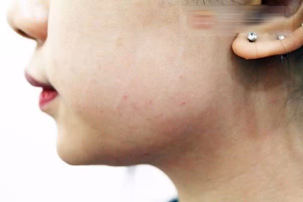 Tiêm xong trên mặt Hạt Mít vẫn còn những nốt đỏ, nhất là ở những vùng da mỏng. Nhưng ngay hôm sau cô có thể trang điểm bình thường và các nốt sẽ biến mất trong một tuần. Chỉ còn phải chờ một tháng nữa để khuôn mặt nhỏ dần lại mà không cần đến phẫu thuật đau đớn.