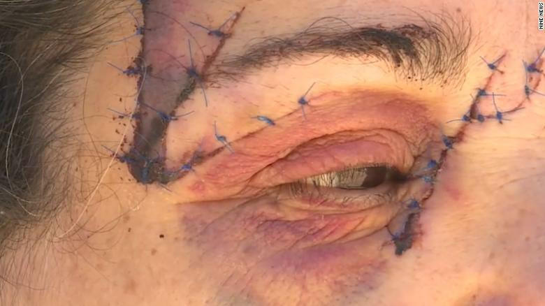 Khiep dam kangaroo tan cong nguoi, may man chi phai khau 25 mui