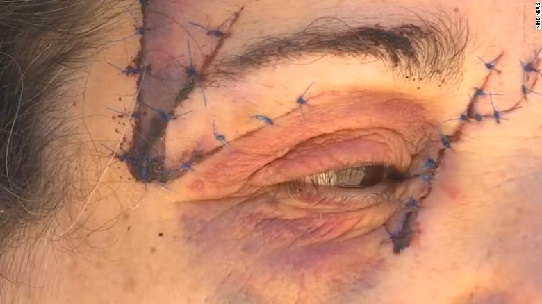 Khiep dam kangaroo tan cong nguoi, may man chi phai khau 25 mui