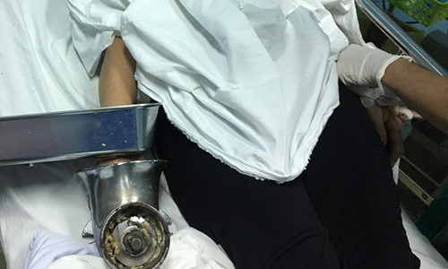 Nguoi phu nu vo tinh bi cuon ca ban tay vao may xay thit