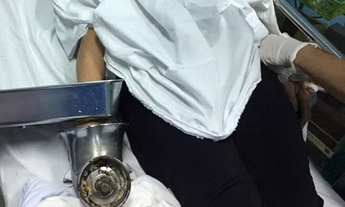 Nguoi phu nu vo tinh bi cuon ca ban tay vao may xay thit