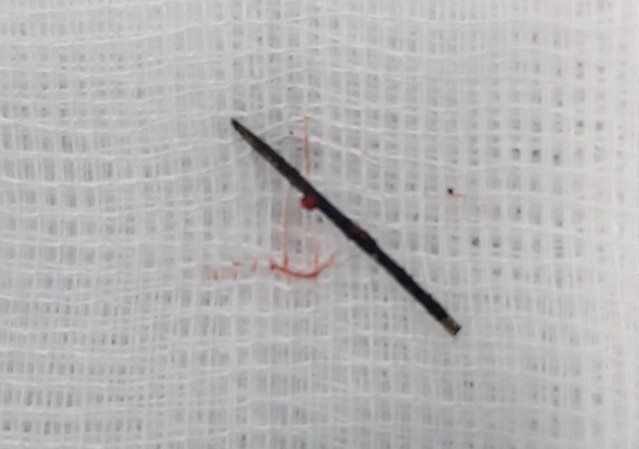 Kim khau gi den trong co the be gai 3 tuoi