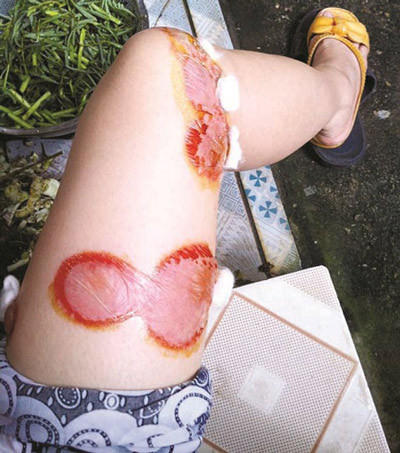 Dấu hiệu dễ nhận thấy là bọ xít hút máu có chiều dài từ khoảng 1-3,5cm, phần bụng rộng và dẹp, ở rìa thân có sọc màu vàng, thân có màu nâu đặc trưng. Bọ xít hút máu người tấn công thường để lại vết thương sưng to, thậm chí còn gây sốt cho nạn nhân. Tại vết đốt thường đau, rát, sưng và rất dễ lan rộng ra xung quanh khi bị tác động vào. Thậm chí các vết đốt sưng to, phù nề có thể làm chân tay không cử động được. Điều đáng lo ngại là hiện nay chưa có thuốc đặc trị loài côn trùng này.