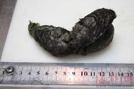 Búi tóc khô cong, đóng thành khối cứng nặng 3,5 lạng được lấy ra từ dạ dày bé N.