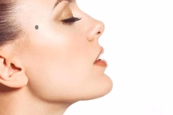  Nốt ruồi ở hai bên trán, gần chân tóc, ngang với vị trí lông mày: Những người này phải đặc biệt chú ý an toàn khi đi ra ngoài, có nguy cơ gặp phải nguy hiểm, dễ gặp phải tai họa bất ngờ, và cần chú ý hơn khi tham gia giao thông. 