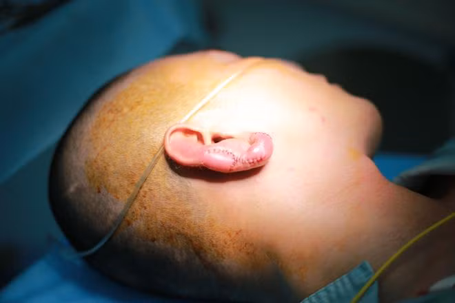 Tiem filler de co tai Phat, ai ngo thanh… tai thoi-Hinh-2