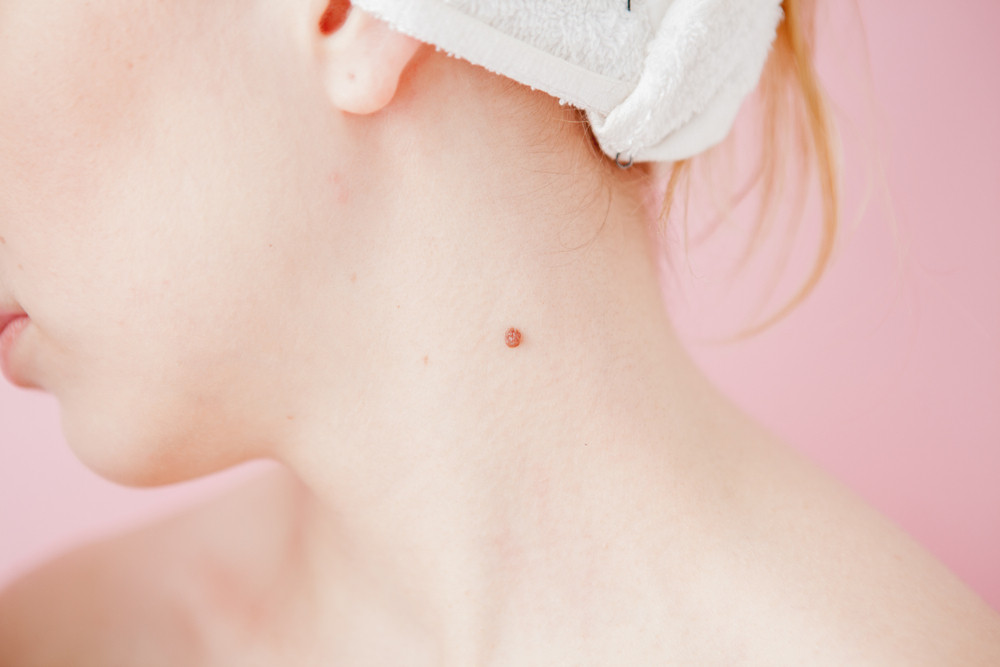 Nốt ruồi ở cổ. Vị trí nốt ruồi mang ý nghĩa đại cát tiếp theo chính là tại vị trí cổ hướng bên phải. Khi cổ bên phải xuất hiện nốt ruồi, điều đó chứng tỏ bạn là tuýp người không cần lo lắng về vấn đề tiền bạc và luôn có vận khí tốt, may mắn đi theo, tiền hết rồi lại sẽ có ngay. Và ngược lại với những bạn có nốt ruồi ở vị trí bên trái của cổ, chúng mang ý nghĩa hoàn toàn trái ngược với vị trí bên phải, khiến bạn gặp nhiều vận xui, không may mắn. 