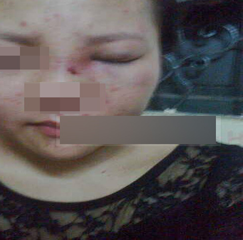 Đây là khuôn mặt với một vài vết thương vẫn chưa lành của Giang A. sau khi bị chồng sắp cưới đánh đập. Được biết khi bị Tuyên A. đánh, Giang A. đang mang bầu 3 tháng và đáng nói hơn là việc Tuyên A. đánh vợ sắp cưới chỉ xuất phát từ một nguyên nhân nhỏ nhặt, vớ vẩn.