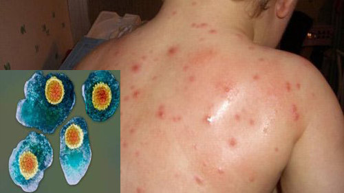 Sởi (tiếng Anh là measles hay rubeola) là bệnh thường sảy ra trong nhi khoa. Trước đây bệnh xảy ra rất thường xuyên và có tỷ lệ lây nhiễm cũng như tử vong rất cao nhưng hiện nay không còn phổ biến nhờ vào chương trình tiêm chủng mở rộng. Sởi là một bệnh nhiễm virus cấp tính đặc trưng ở giai đoạn cuối bằng ban dạng dát-sẩn xuất hiện tuần tự từ cổ, mặt, ngực, thân, chân tay kèm theo sốt cao.