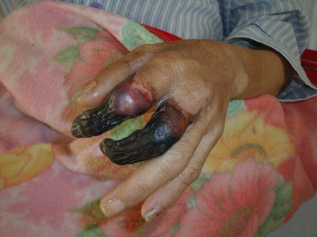 Uốn ván là chứng bệnh làm co giật căng cứng các bắp thịt trong cơ thể thường làm chết người. Nguyên nhân là do chất độc neurotoxin khi bị nhiễm vi trùng Clostridium tetani qua vết thương trên da. Triệu chứng là tê cứng lưỡi và hàm, sau đó giật cứng cả người và khi hệ cơ của lồng ngực bị cứng sẽ khó thở, và gây tử vong.