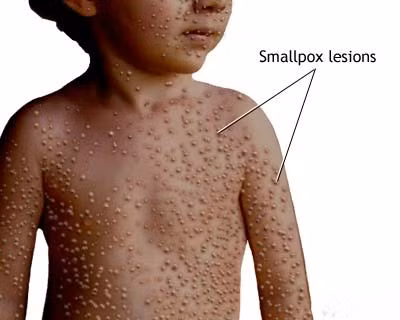 Đậu mùa là nguyên nhân gây ra cái chết của khoảng 500 triệu người trong thế kỷ 20. Bệnh này được xem là một trong những tai họa khủng khiếp nhất của loài người.