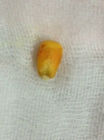 Hạt ngô mắc trong phế quản cháu N.