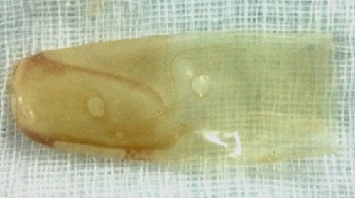 Ngón gang tay cao su mắc trong phế quản cháu A.