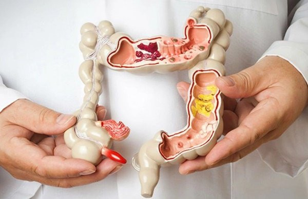 3 mon nen an va 3 mon can tranh de ngua ung thu ruot