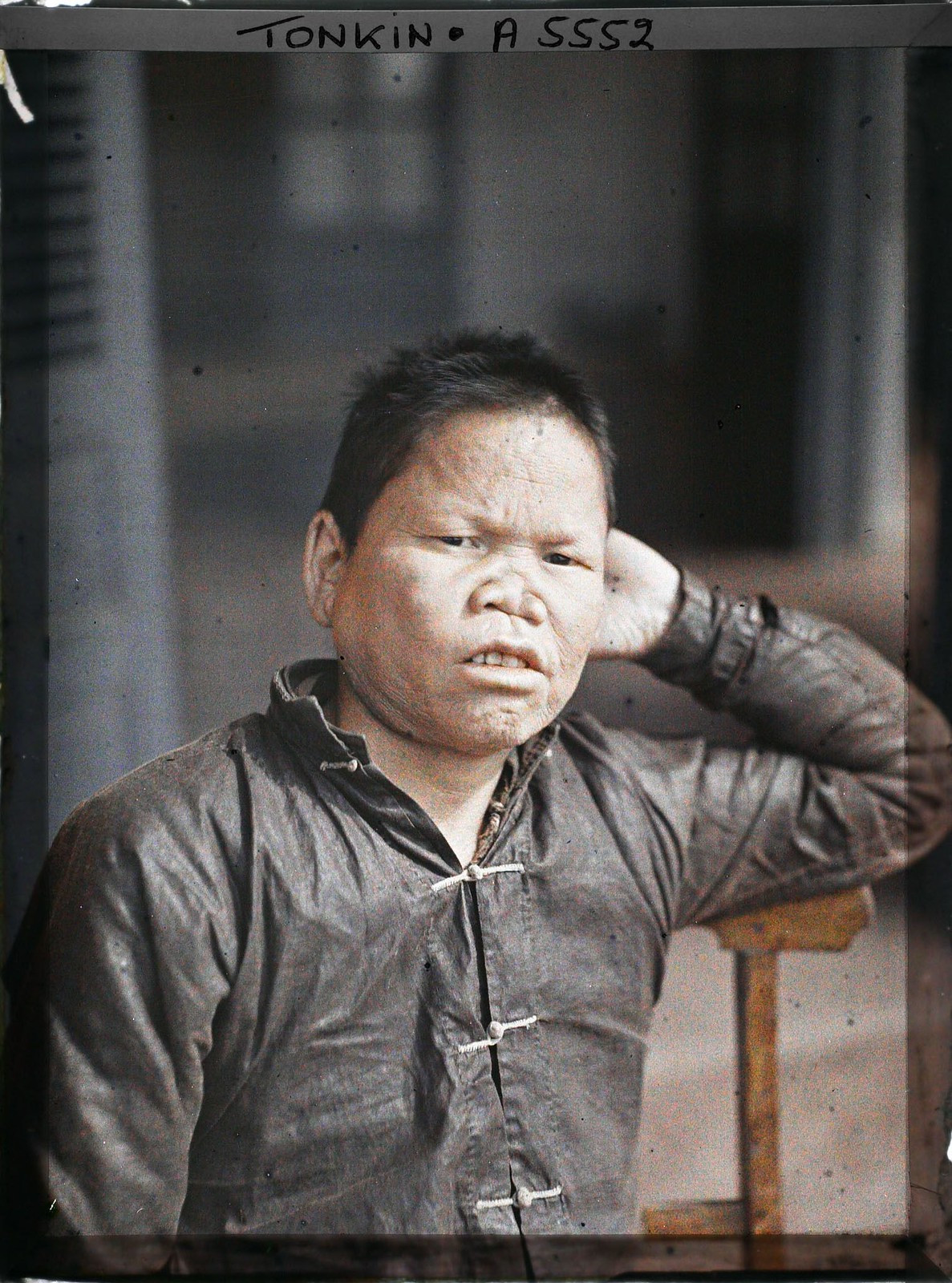 Chân dung một bệnh nhân cùi ở Yên Duyên.