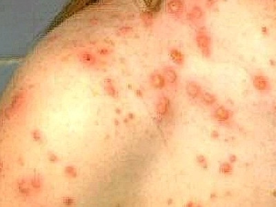 Trên cơi thể xuất hiện n hững nốt nhỏ xíu với trung tâm mầu xanh trắng xuất hiện bên trong miệng nơi gò má. Những nốt này có tên là đốm Koplik. Hoặc mọc ra những đốm đỏ lớn, phẳng, chập vào nhau. Từ khoảng ngày thứ hai - ba từ khi mọc ban, cơ thể sinh kháng thể. Kháng thể tăng lên thì virus bị loại khỏi máu. Bệnh chuyển sang thời kì lui bệnh.