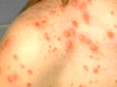 Trên cơi thể xuất hiện n hững nốt nhỏ xíu với trung tâm mầu xanh trắng xuất hiện bên trong miệng nơi gò má. Những nốt này có tên là đốm Koplik. Hoặc mọc ra những đốm đỏ lớn, phẳng, chập vào nhau. Từ khoảng ngày thứ hai - ba từ khi mọc ban, cơ thể sinh kháng thể. Kháng thể tăng lên thì virus bị loại khỏi máu. Bệnh chuyển sang thời kì lui bệnh. Trên cơi thể xuất hiện n hững nốt nhỏ xíu với trung tâm mầu xanh trắng xuất hiện bên trong miệng nơi gò má. Những nốt này có tên là đốm Koplik. Hoặc mọc ra những đốm đỏ lớn, phẳng, chập vào nhau. Từ khoảng ngày thứ hai - ba từ khi mọc ban, cơ thể sinh kháng thể. Kháng thể tăng lên thì virus bị loại khỏi máu. Bệnh chuyển sang thời kì lui bệnh.