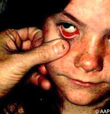 Tiếp đến trẻ nhiễm sởi có thể bị mắt đỏ...