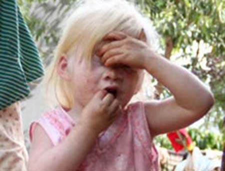 Từ máu, theo các bạch cầu, virus đến các phủ tạng (phổi, lách, hạch, da…) gây tổn thương các cơ quan và cac triệu chứng lâm sàng thời kì toàn phát. Ban ở da và niêm mạc chính là hiện tượng đào thải virus của cơ thể đã phản ứng miễn dịch bệnh lí.