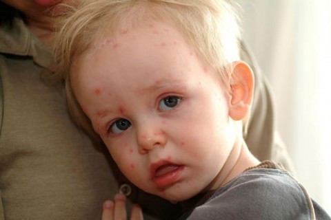 Tiếp đến là sốt và sợ ánh sáng. Đây cũng là những biểu hiện khá đặc trưng khi trẻ nhiễm sởi. Một khi siêu vi sởi vào cơ thể bệnh nhân, chúng thường mọc vào trong những tế bào đằng sau cổ họng và phổi. Sau đó bệnh sẽ lan khắp cơ thể kể cả hệ hô hấp và da.