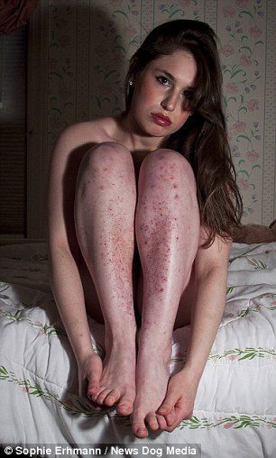 Sau nhiều năm giấu diếm căn bệnh của mình,đến năm 19 tuổi, cô nói thật với mẹ và đi khám bác sĩ nhưng đã quá muộn. Các vết thương chảy máu, bầm tím và nhiễm trùng dẫn đến tổn thương vĩnh viễn .