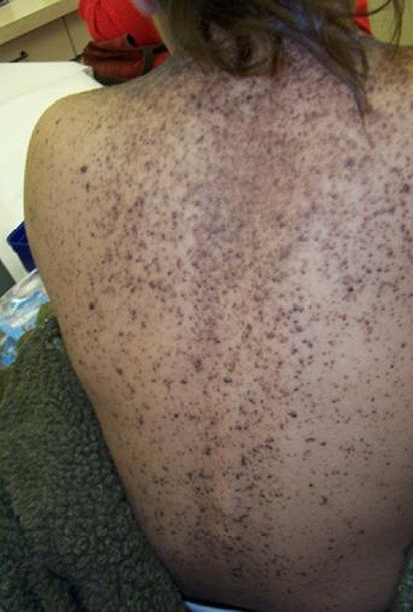 Hội chứng tế bào nevus: nhiều tế bào đáy trên lưng của một đứa trẻ.