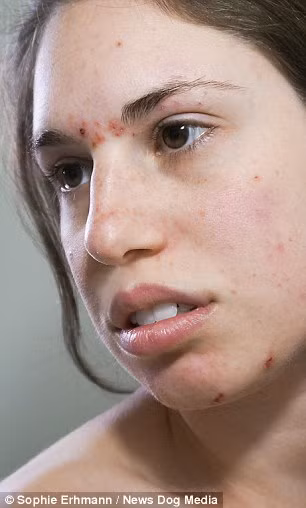 Cô gái sinh ra tại New York có triệu chứng từ năm 12 tuổi. Đến khi 17 tuổi, da mặt, chân, nách, ngực và vùng bikini bắt đầu bong tróc, để lại rất nhiều vết sẹo trên cơ thể.