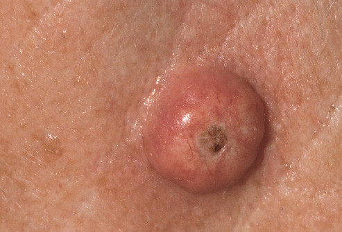 Keratoacanthoma (KA) là một tổn thương đặc biệt, thường xuất hiện trên mặt, và bắt chước ung thư biểu mô tế bào vảy. Tốc độ phát triển của nó vô cùng nhanh chóng.