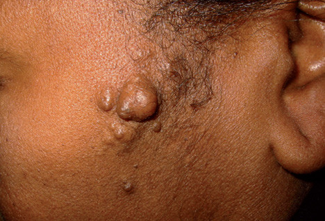 Neurofibromas (NFS) là khối u lành tính, mềm, màu hồng, có thể xuất hiện đơn độc hay nhiều thành hệ thống.