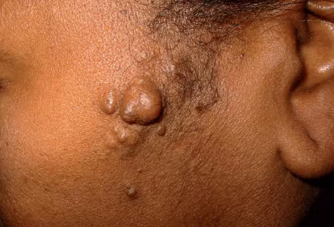 Neurofibromas (NFS) là khối u lành tính, mềm, màu hồng, có thể xuất hiện đơn độc hay nhiều thành hệ thống.