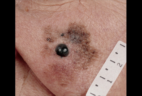 Khối u ác tính Lentigo Maligna : Một trong bốn loại lâm sàng của u ác tính và phát triển chậm nhất. Nó thường bắt đầu như một vết đốm có màu nâu đậm, nâu, hoặc màu đen trên da, chẳng hạn như trên mặt.