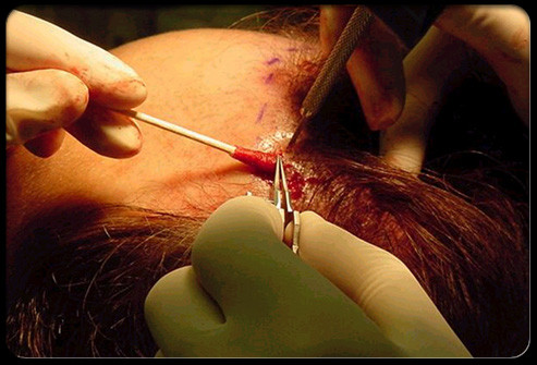 Phương pháp phẫu thuật bao gồm cấy ghép tóc (lấy tóc từ phía sau và đặt nó gần phía trước) hoặc giảm da đầu (cắt bỏ các khu vực hói và khâu phần còn lại với nhau). Thủ tục cấy ghép đã được cải thiện đáng kể trong những năm gần đây.