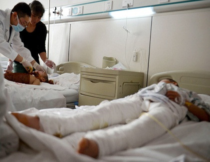 Hai anh em bị đốt cháy tại Mawang (Trung Quốc) được điều trị tại một bệnh viện ở Bắc Kinh vào tháng 5. Hai anh em bị đốt cháy tại Mawang (Trung Quốc) được điều trị tại một bệnh viện ở Bắc Kinh vào tháng 5.