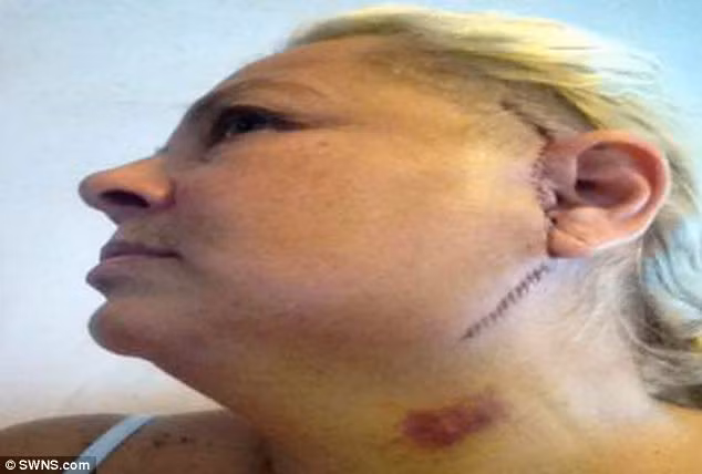 Bà không thể ăn, uống, nói chuyện trong vài tháng mà chỉ truyền nước qua 1 ống dẫn vào cơ thể. Nhưng nhờ một loại phẫu thuật hiếm chỉ diễn ra 75 lần mỗi năm, bà đã trở lại cuộc sống bình thường.