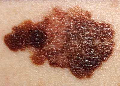 Nếu có bất kỳ thay đổi nào trên da như mụn cóc hay nốt ruồi, đây có thể là dấu hiệu của khối u ác tính, còn được gọi là ung thư da. Hãy đến gặp bác sĩ da liễu ngay lập tức để điều trị dễ dàng hơn khi được phát hiện sớm.