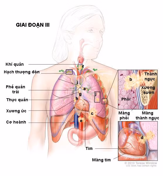 Viện Ung thư Quốc gia đã phân tích dữ liệu từ các sàng lọc liên quan đến 53.452 người có nguy cơ cao đối với bệnh ung thư phổi được theo dõi trong khoảng sáu năm.