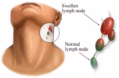 Nghiên cứu mới cho thấy ngay cả những người có khối u không co lại cũng có thể được hưởng lợi, bởi vì làm hóa trị trước có thể làm giảm sự lây lan của ung thư đến các hạch bạch huyết.