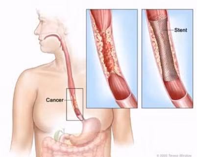 Ung thư thực quản là một bệnh ác tính khó chẩn đoán sớm. Ung thư hình thành ở lớp niêm mạc của thực quản, thực quản, ống đưa thức ăn từ họng đến dạ dày và thường gặp ở những người hút thuốc, uống rượu, thừa cân, có chế độ ăn uống nghèo nàn các loại trái cây tươi và rau quả.