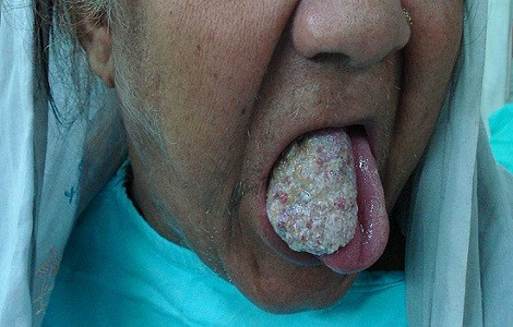 Ung thư biểu mô tế bào vảy tại chỗ: bệnh Bowen. Vết lớn có vảy, ban đỏ mô phỏng một mảng tổn thương như vảy nến.