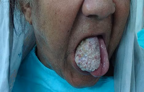 Ung thư biểu mô tế bào vảy tại chỗ: bệnh Bowen. Vết lớn có vảy, ban đỏ mô phỏng một mảng tổn thương như vảy nến.