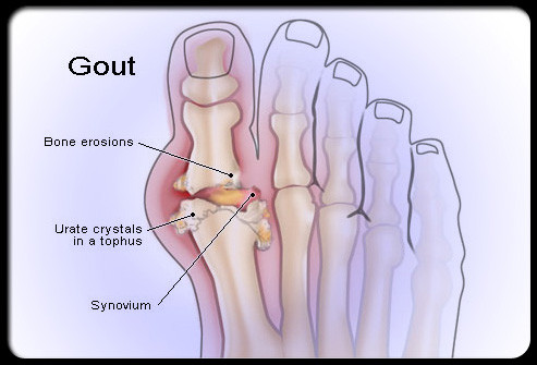  Bệnh gút là tình trạng đau đớn do sự hình thành các tinh thể uric axit trong khớp. Mặc dù một số trường hợp là do di truyền, nhưng rượu và các yếu tố chế độ ăn uống khác cũng là tác nhân gây bệnh.