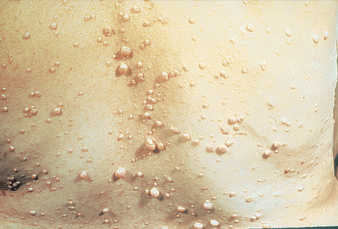 Sẩn và nhiều nốt mềm da màu ở sau lưng là dạng u neurofibromata, thường xuất hiện trong tuổi vị thành niên.