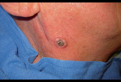 Ung thư biểu mô tế bào vảy : tế bào mỏng, phẳng, nhìn dưới kính hiển vi như vảy cá. Các tế bào vảy được tìm thấy trong bề mặt của da, niêm mạc các cơ quan rỗng của cơ thể, những đoạn của đường hô hấp và đường tiêu hóa.