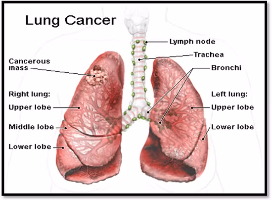 Hơn 200.000 người Mỹ được chẩn đoán mắc bệnh ung thư phổi mỗi năm, và hơn một nửa trong số họ chết. Trên toàn thế giới, hàng năm có khoảng 1,5 triệu ca tử vong do ung thư phổi.
