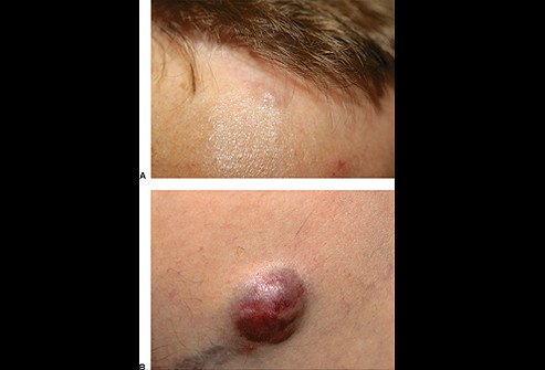 Tế bào ung thư biểu mô Merkel : không hay gặp nhưng rất ác tính. Nó bắt đầu ở một số khu vực chịu nắng (đầu, cổ, cánh tay hoặc chân), không đau, có màu đỏ, hồng, màu xanh và thay đổi kích thước đường kính từ nửa cm đến 5cm.