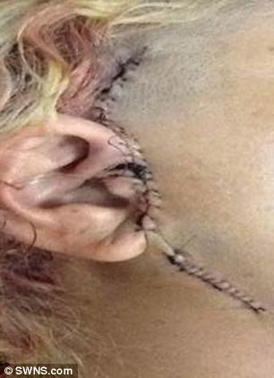 Các bác sĩ đã đưa những tấm titan trị giá 16.000 bảng Anh (khoảng 572 triệu đồng) vào hàm của bà Clarke. Dù cấy ghép phù hợp nhưng bà vẫn gặp rắc rối vì loạn trương lực làm cơ hàm mới bị trật.