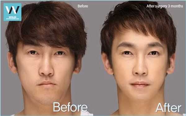 Chàng trai này đã phẫu thuật chỉnh cằm lệch...