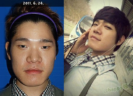 Công nghệ dao kéo có thể biến hóa khuôn mặt thô, đường nét không cân xứng thành hotboy.