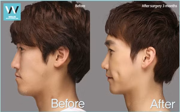 và tạo má lúm đồng tiền để có khuôn mặt đẹp nhân tạo.